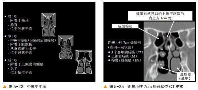 超清图解:鼻窦及颅底ct解剖