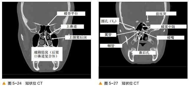 超清图解:鼻窦及颅底ct解剖