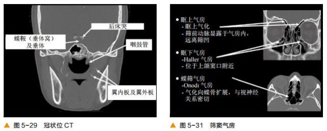 前后筛窦以中鼻甲基板为界,蝶窦及后组筛窦以上鼻甲基板为界.