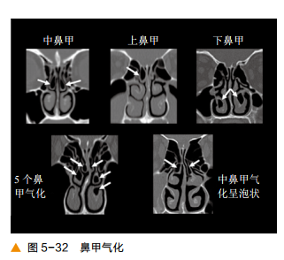 前后筛窦以中鼻甲基板为界,蝶窦及后组筛窦以上鼻甲基板为界.