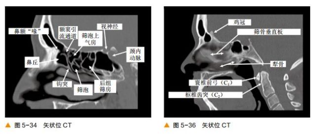 超清图解:鼻窦及颅底ct解剖