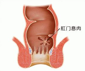 西安东大肛肠医院丨肛门口有小肉球和异物感是怎么回事?