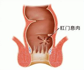 肛门口有小肉球和异物感是怎么回事?