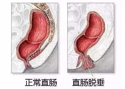 肛门口有小肉球和异物感是怎么回事?