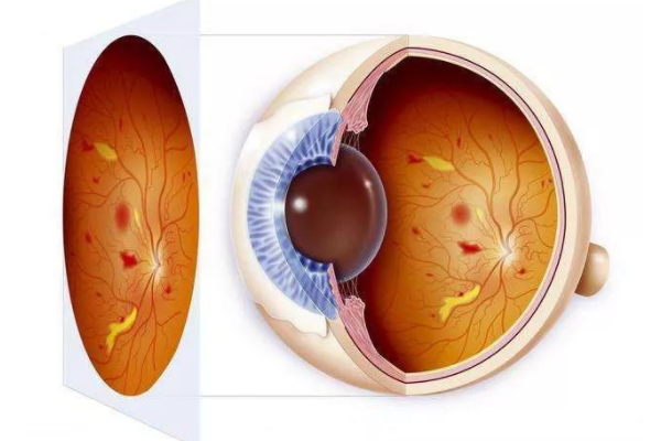 什么是糖尿病视网膜病变