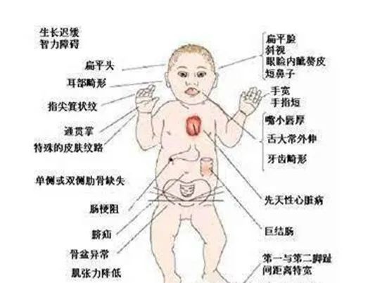 刚满月孩子被查出唐氏儿,如今宝妈终日以泪