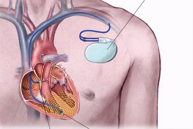 心脏不适就要装心脏起搏器?安装后有什么需要注意的
