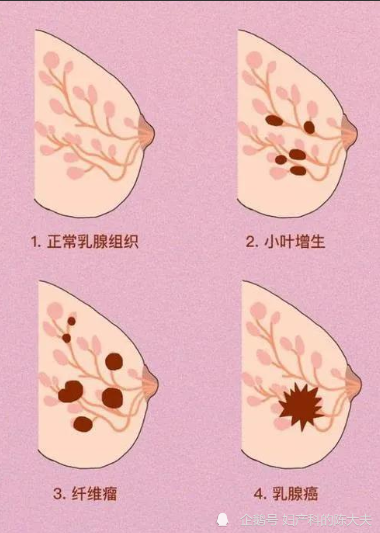 体检发现乳腺结节怎么办?