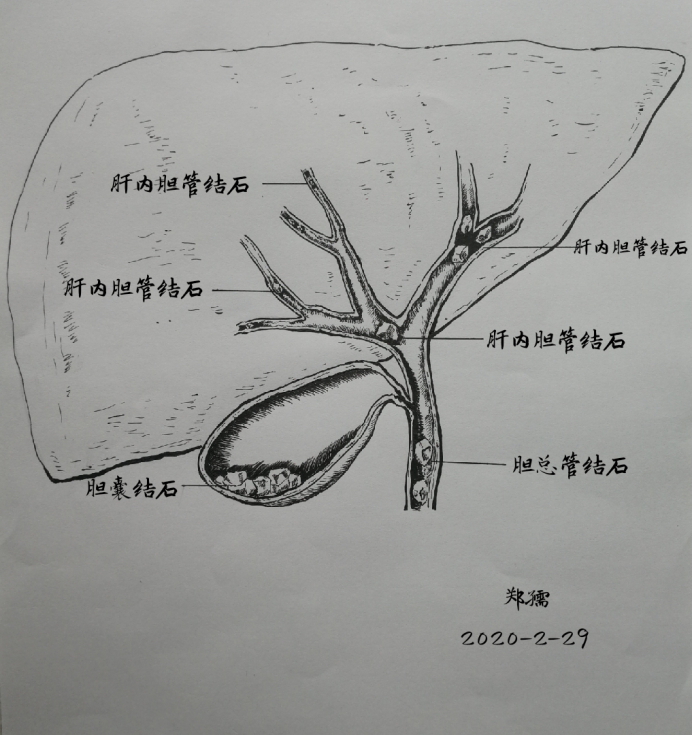 肝内胆管结石长达12cm是什么病因