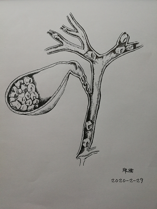 肝内胆管结石长达 12 cm,是什么病因?