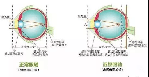 婴幼儿眼散光变化,散光的配镜建议