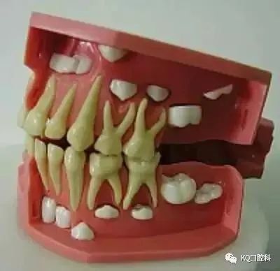 在恒牙萌出的过程中,恒牙的牙冠接触乳牙牙根,使乳牙牙根吸收,接下来