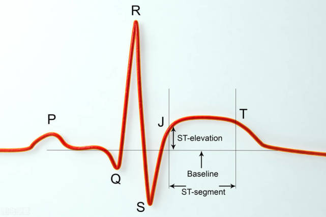 心电图写着:窦性心律,st段改变t波倒置.是心脏病?医生