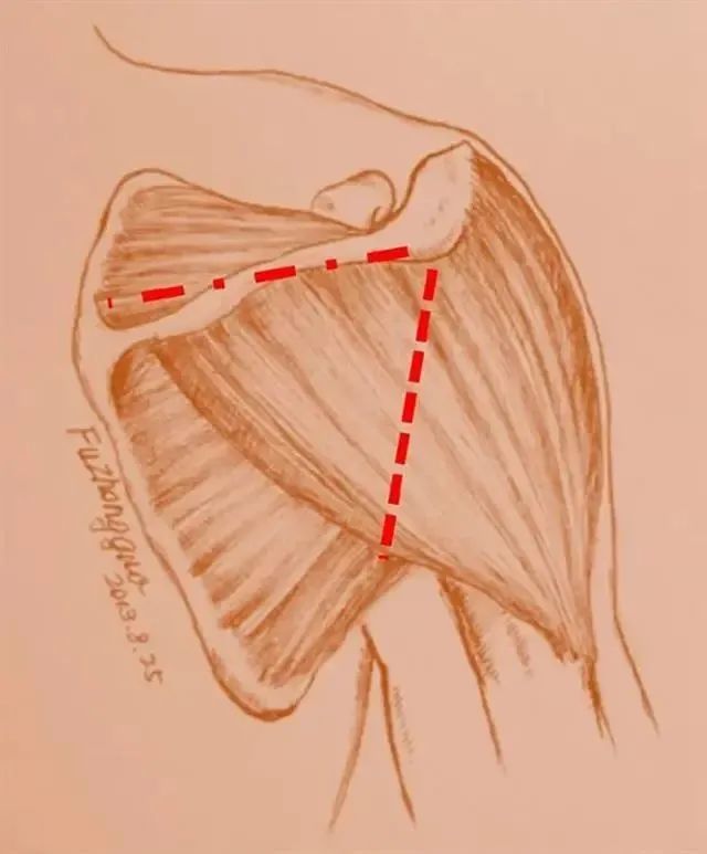 肩胛骨外缘切口,一旦需扩大切口再用切口上缘沿肩胛冈向内侧扩展切口