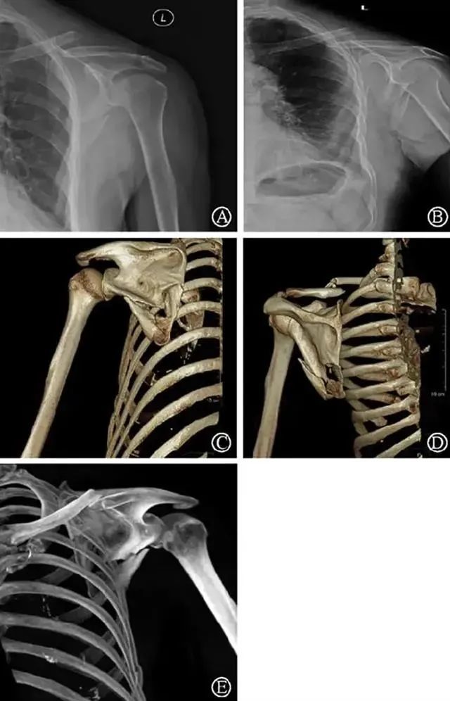 图说肩肘|肩胛骨体部骨折:从手术入路选择到缝线辅助