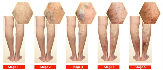 低压力(预防型18mmhg:适用于下肢静脉曲张,静脉性水肿,久坐久立高发