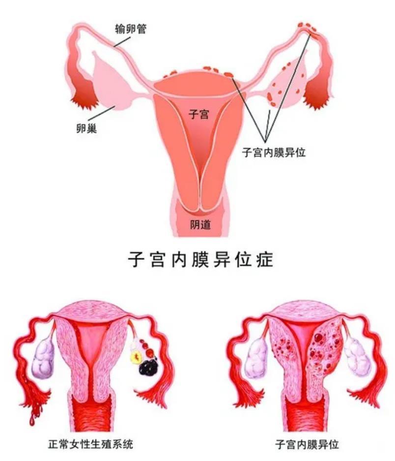 子宫内膜的厚度会越来越薄 慢慢就会导致受精卵不易着床 出现习惯性