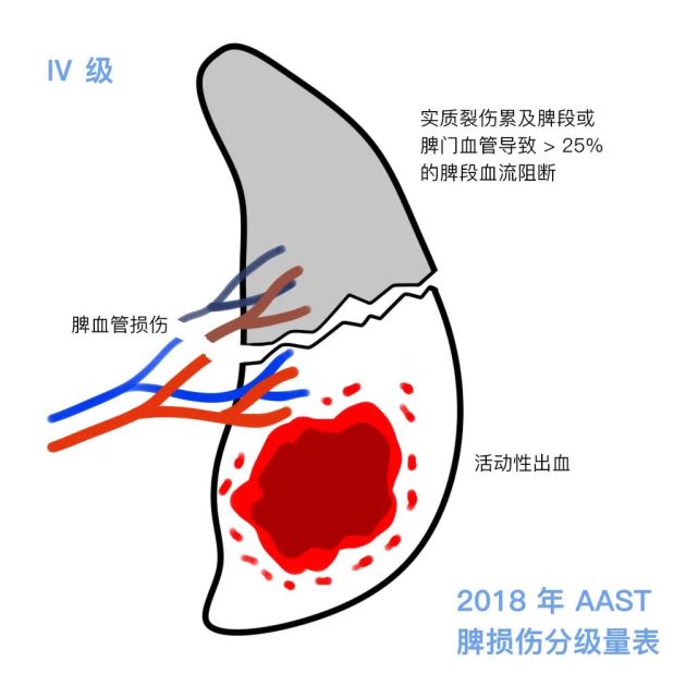 脾破裂伤诊治,三个要点不可不知