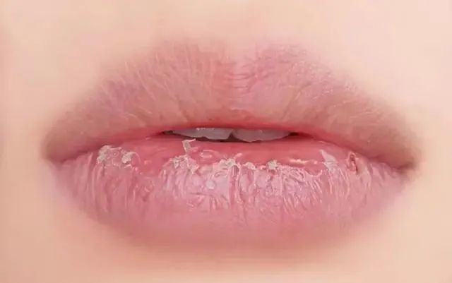 为什么嘴唇经常起皮,还越来越紫?可能是这几个原因