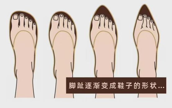 苏敬达讲解:拇外翻需要治疗吗?