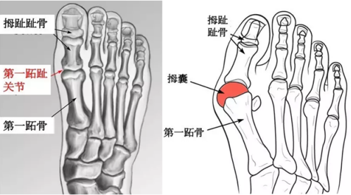 大脚骨医生苏敬达大脚骨的保守治疗方法