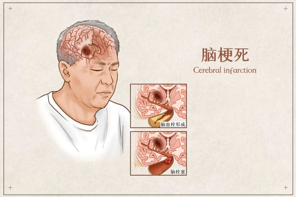 【医疗动态】体检发现颈动脉斑块,该怎么办?