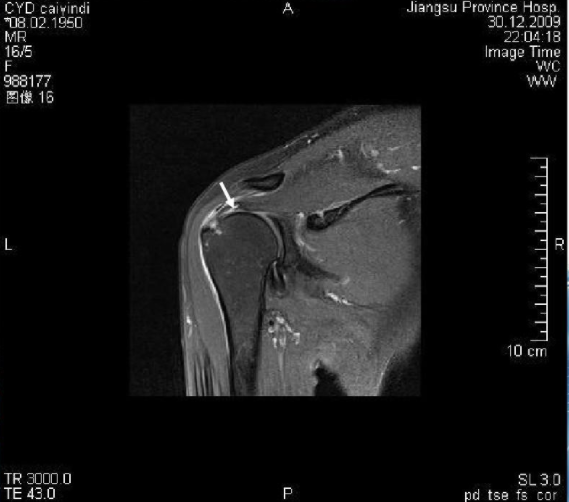 病例影像诊断肩关节疾病的超声诊断及相关解剖