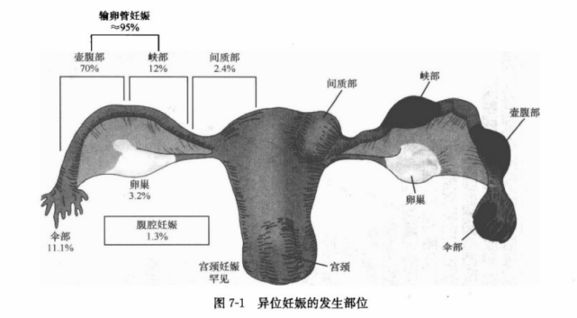 异位妊娠的手术治疗