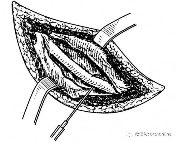 【骨科小技巧】骨科基本手术技能之:骨膜剥离技术!