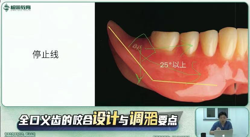 注:95%以上停止线的位置都在磨牙后垫前缘. 四,人工牙的选择