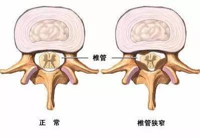 颈椎管狭窄症和腰椎管狭窄症一样吗?引起的走路问题有