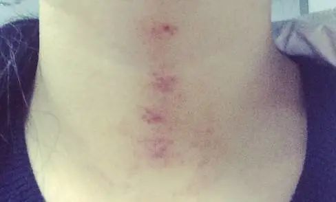 痧,老化细胞坏死,代谢不了,堵在我们的体内 鲜红色的点状代表病程轻在