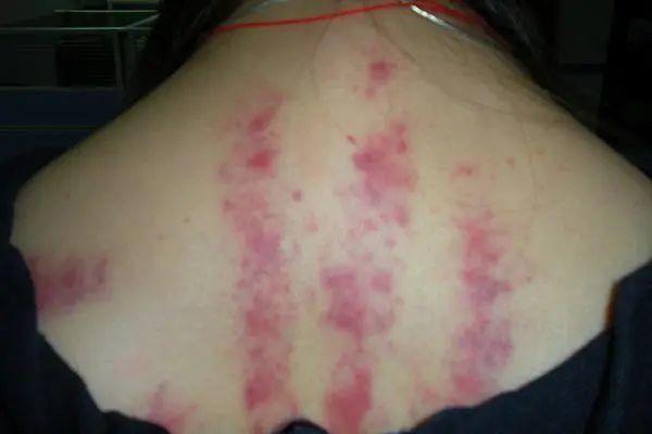 黑痧:寒;紫痧:又毐又堵…看痧印识病体!