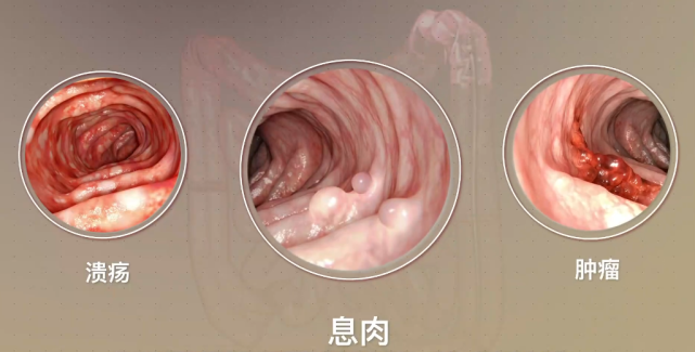 发现肠息肉,我们该怎么办?