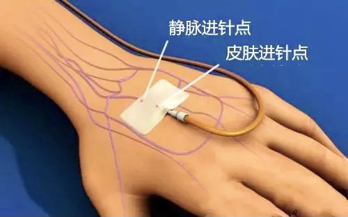 拔针后按压,您按对了的吗?