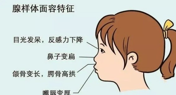 其中腺样体和扁桃体肥大是引起儿童张口呼吸的最常见原因.