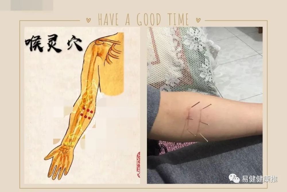 中医针灸鼻腔疾病处方1