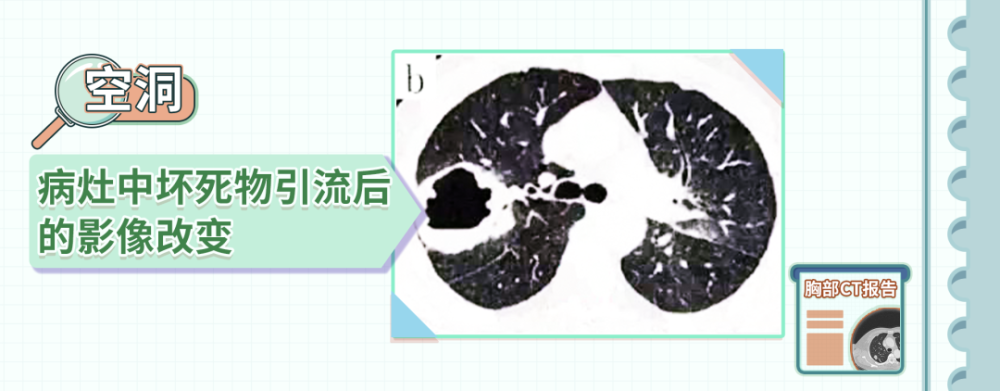 空洞的壁 可以是炎性组织,纤维组织, 还可以是肿瘤组织.