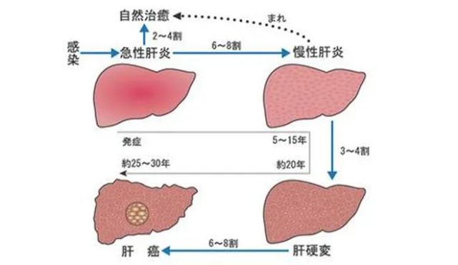 哪些行为会让你的急性肝炎复发