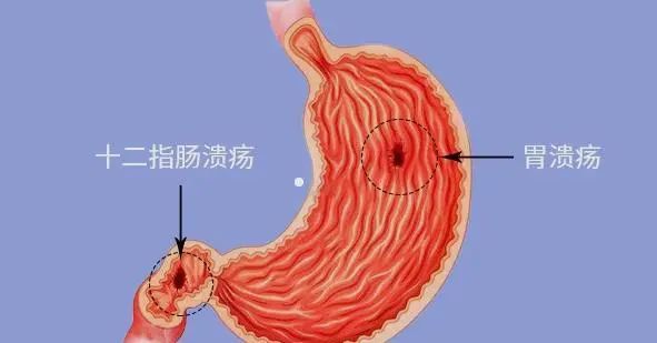 假如十二指肠球部存在溃疡,这些胃酸就会刺激溃疡创面引起疼痛.