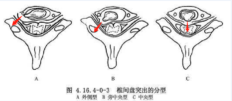 腰椎间盘突出越大,病情就越严重?