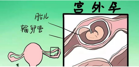 一场"要命"的空欢喜—异位妊娠