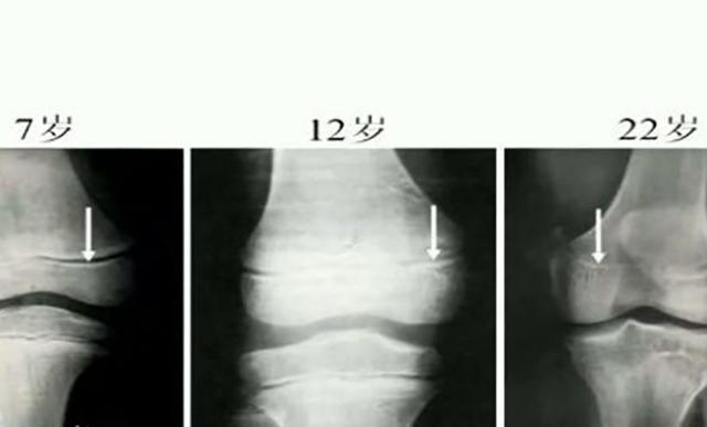 女性18岁前,男性20岁前,骨骺线闭合,基本不再生长.