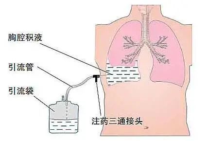 (1)用来引流胸水,只要我们把这套装置放在低于胸腔的位置(比如病人半