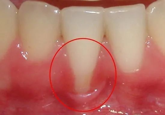 2,牙龈萎缩:牙缝大一般多见于牙龈萎缩导致,牙龈萎缩是不可逆的,重点