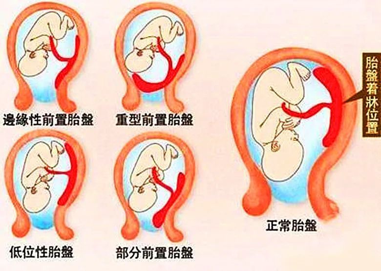 胎盘是否有血管瘤的存在,是否成熟等,可以明确地诊断出前置胎盘,胎盘