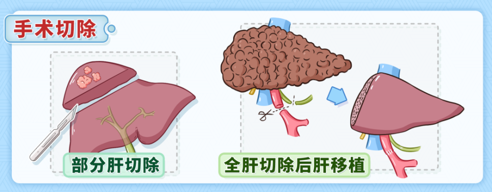 院士讲科普|肝癌怎么治疗?生活中如何护肝?护肝片真的有用吗?