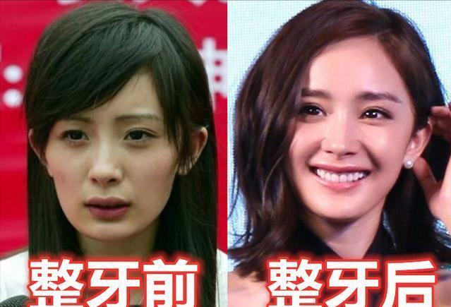 去痣护肤整牙女星整容3大借口下也有人公开承认
