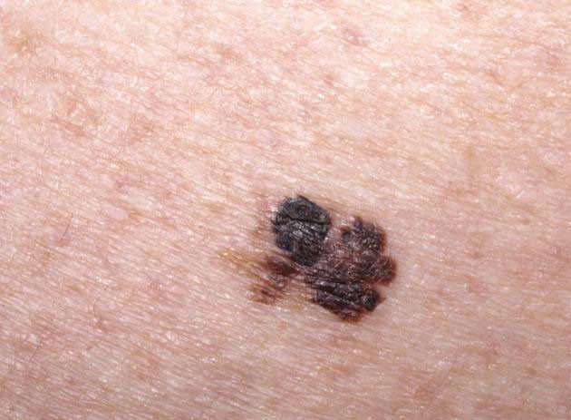 黑色素瘤高发要警惕皮肤出现这4种异常要赶快上医院避免惹上恶性肿瘤