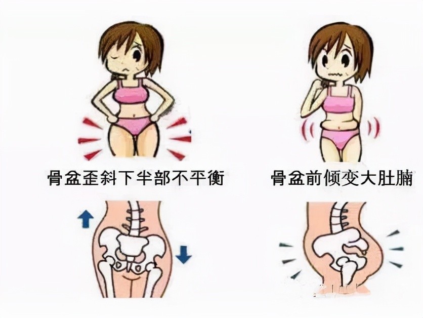 一篇干货让你看懂骨盆修复建议马克